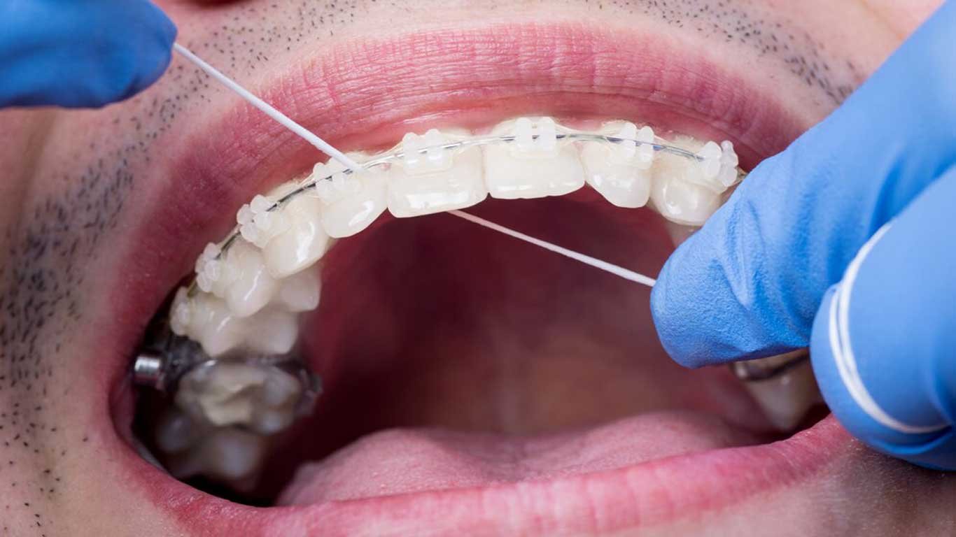 how to keep your braces clean