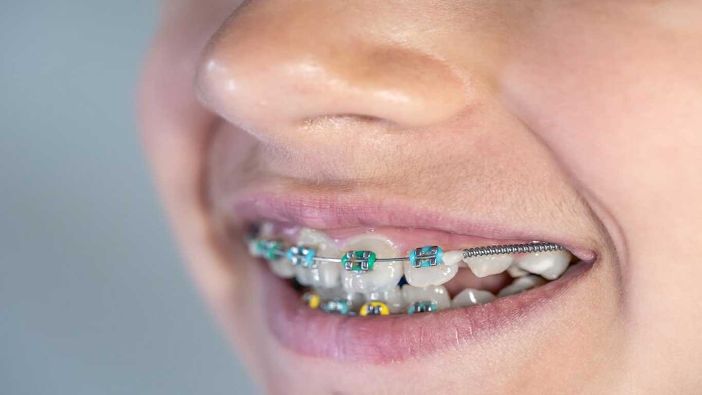 braces color