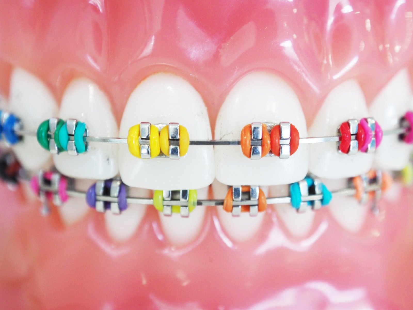 braces' color