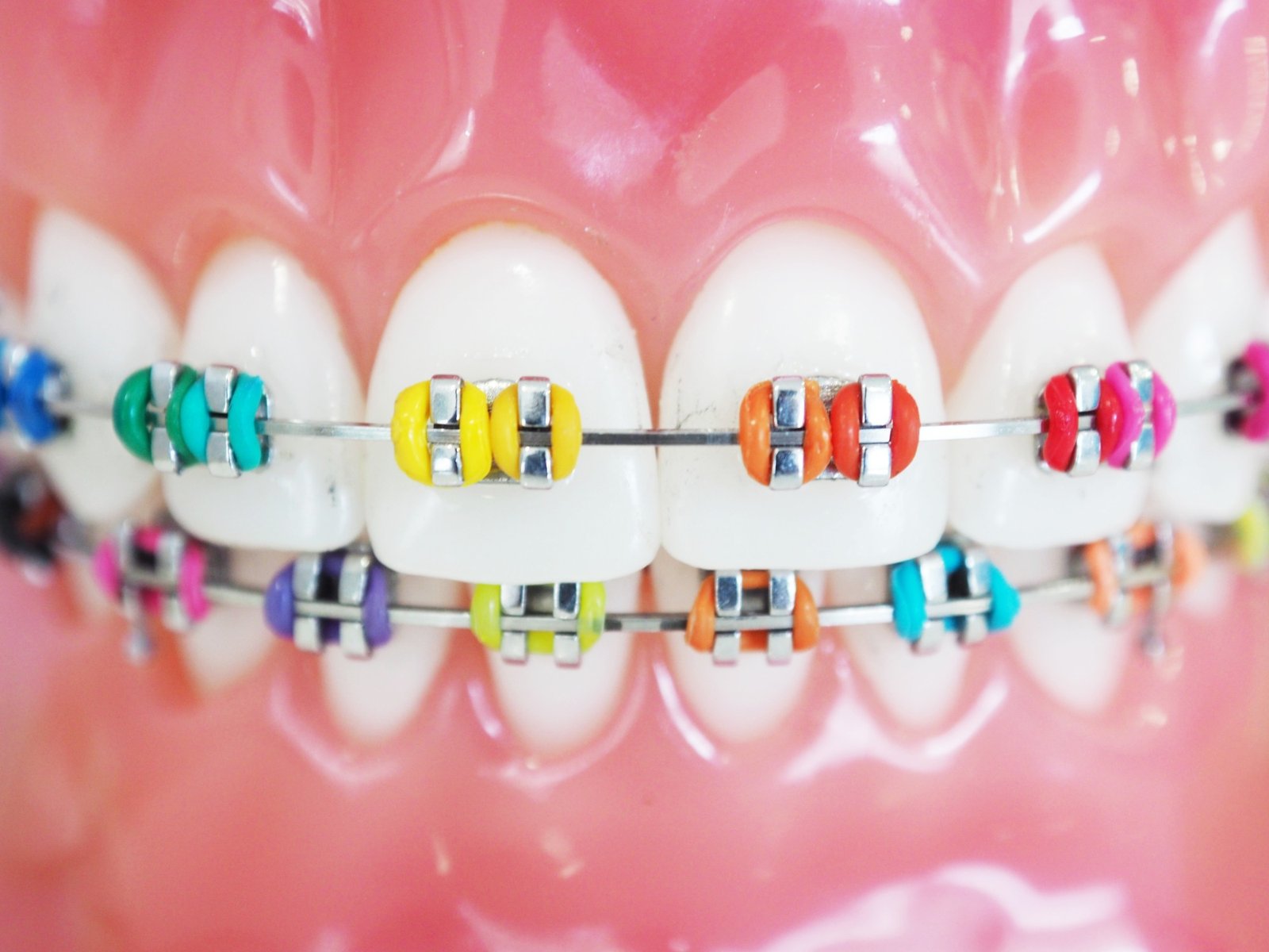 What Braces Color Are Used For Orthodontic Services 