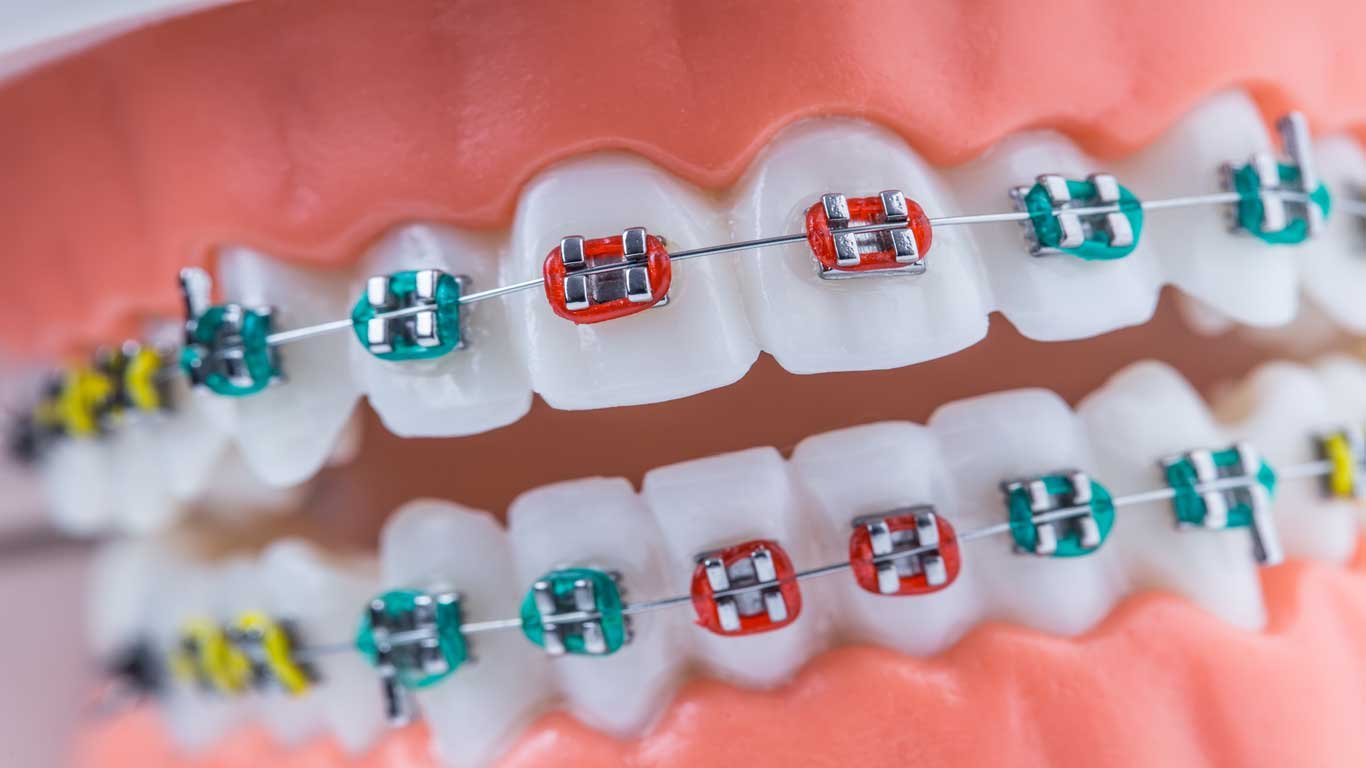 coloreful braces