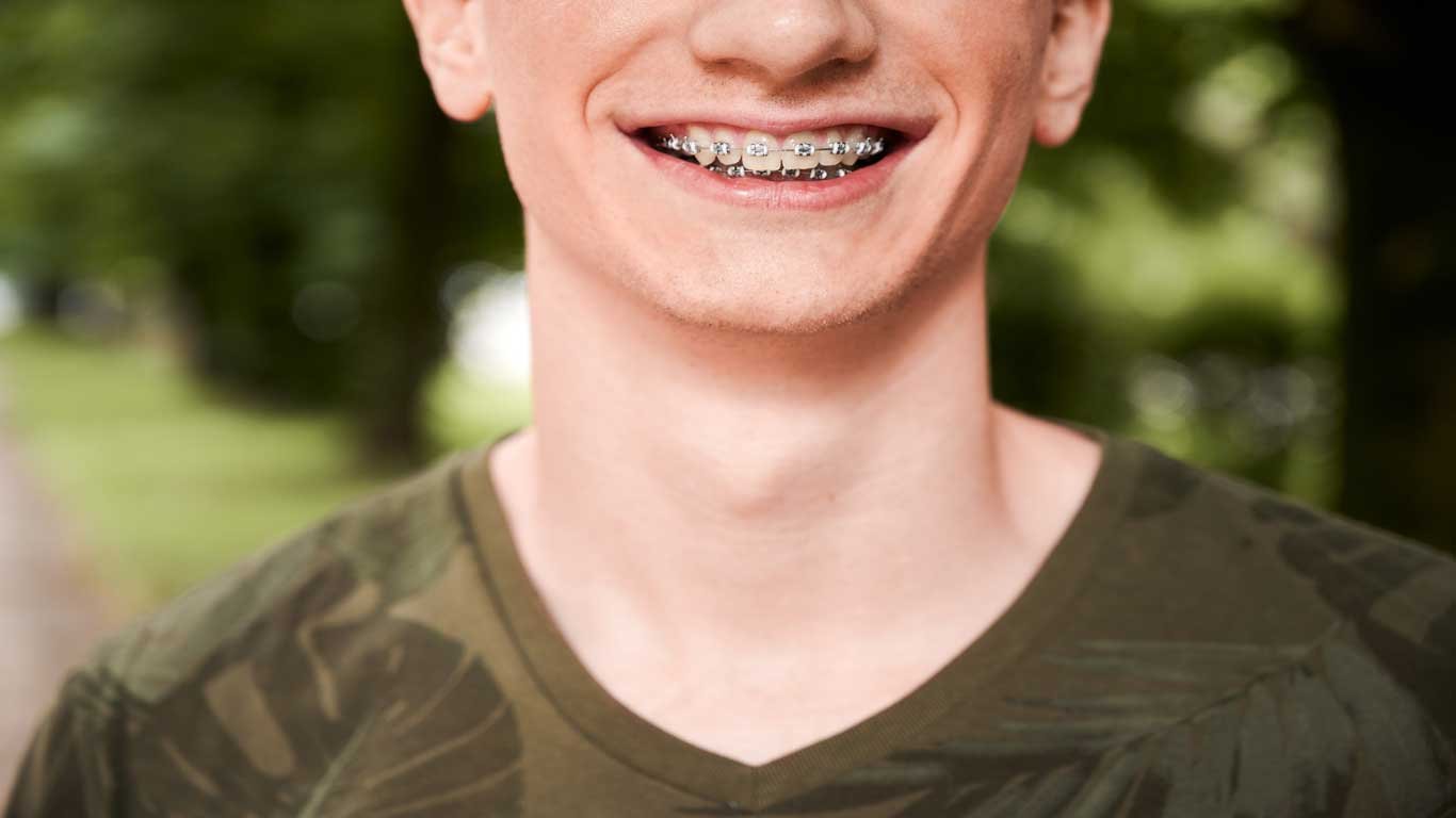 Options when it comes to braces for adults?