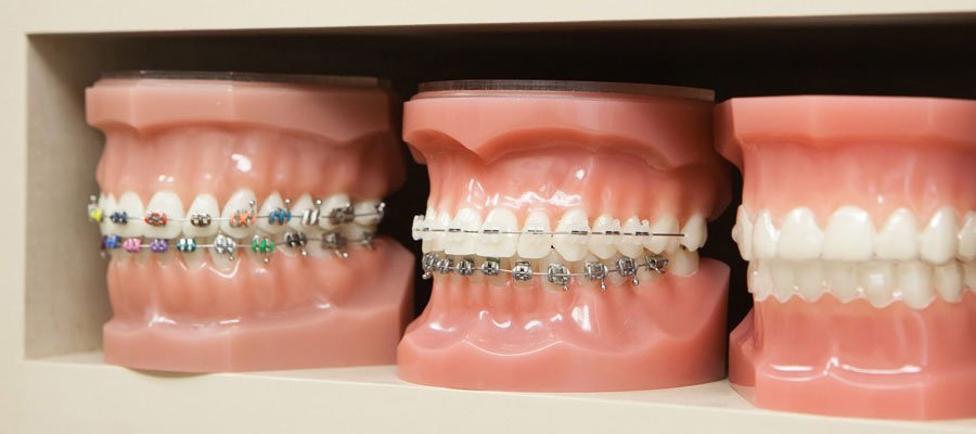 Types of Braces