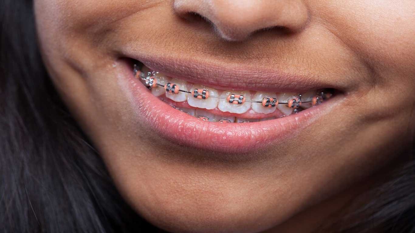 traditional metal braces