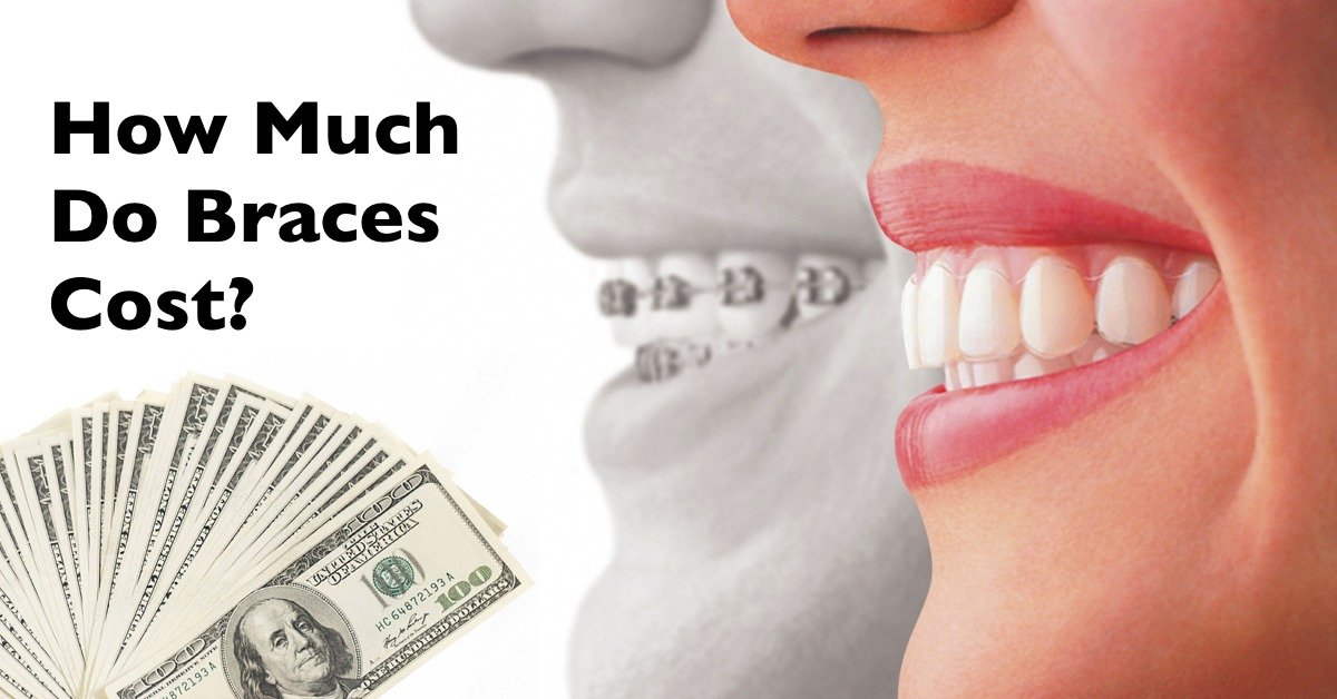 Affording Braces And Getting Your Money’s Worth! Orthodontic Services