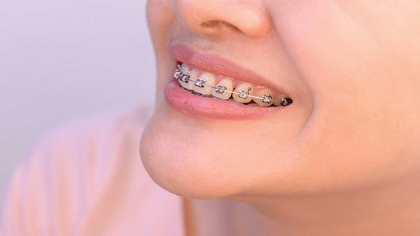 Traditional metal braces- types of braces