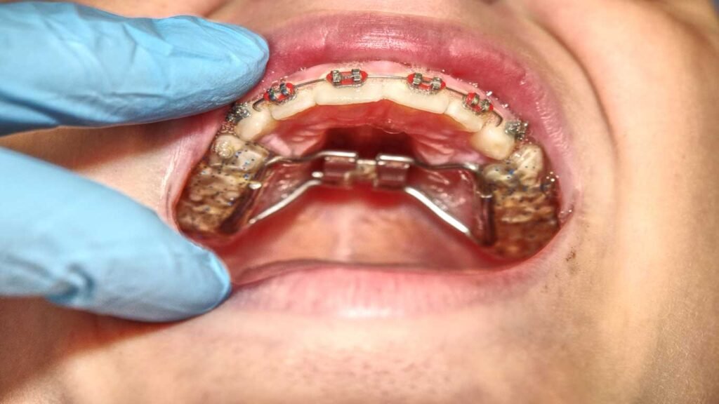 braces problems
