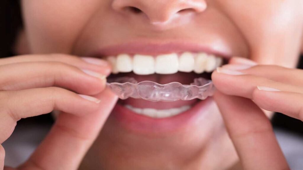 all about Invisalign