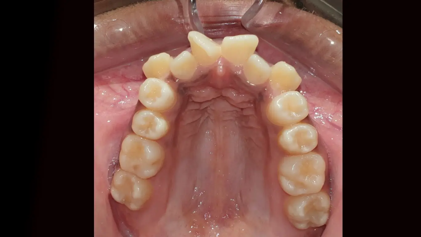 Invisalign in York Orthodontics- Treating Crowding