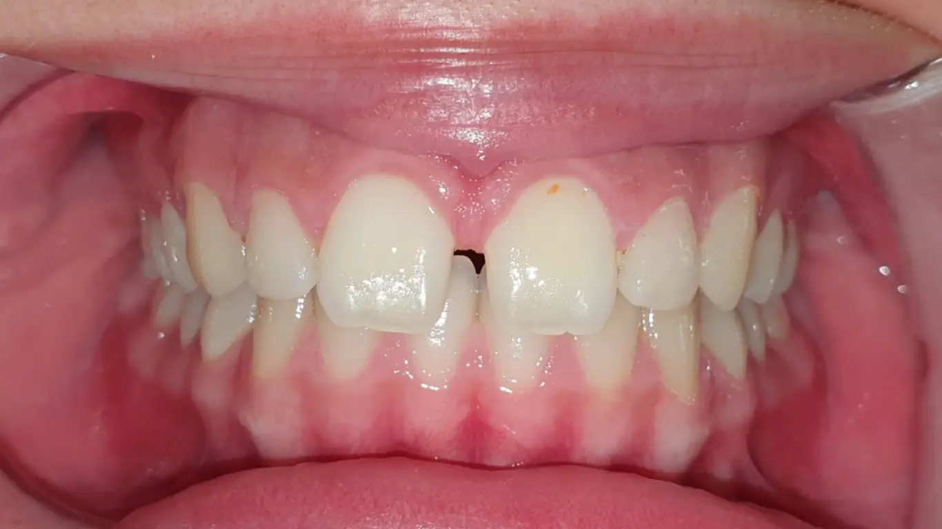 gapped teeth