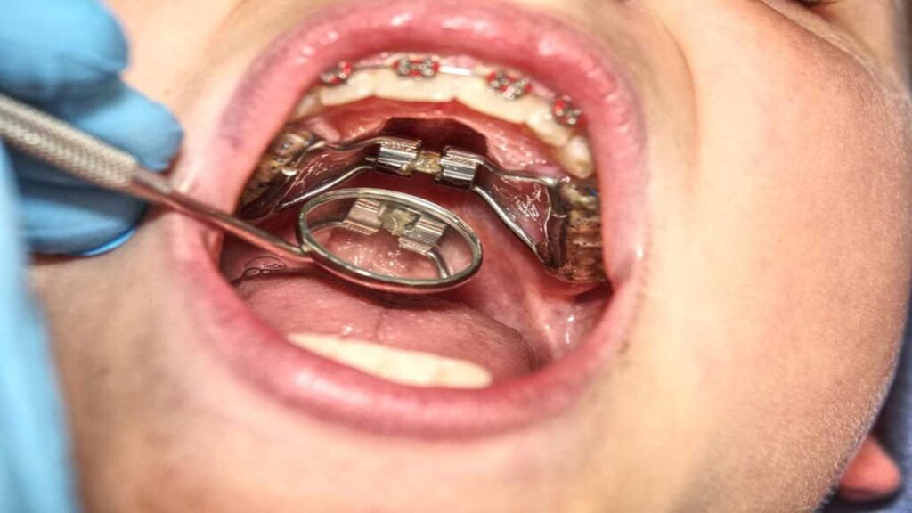 palatal-expander