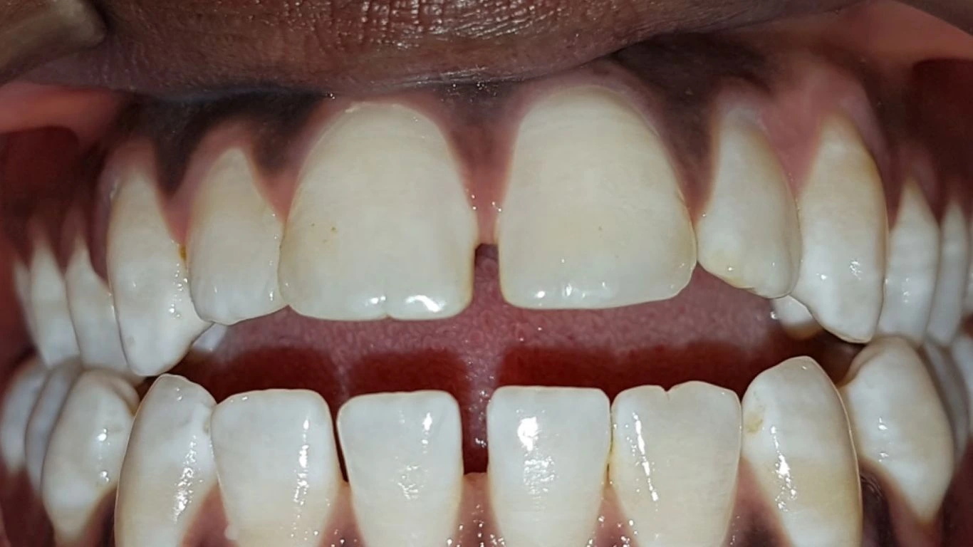 class II malocclusion-overbite