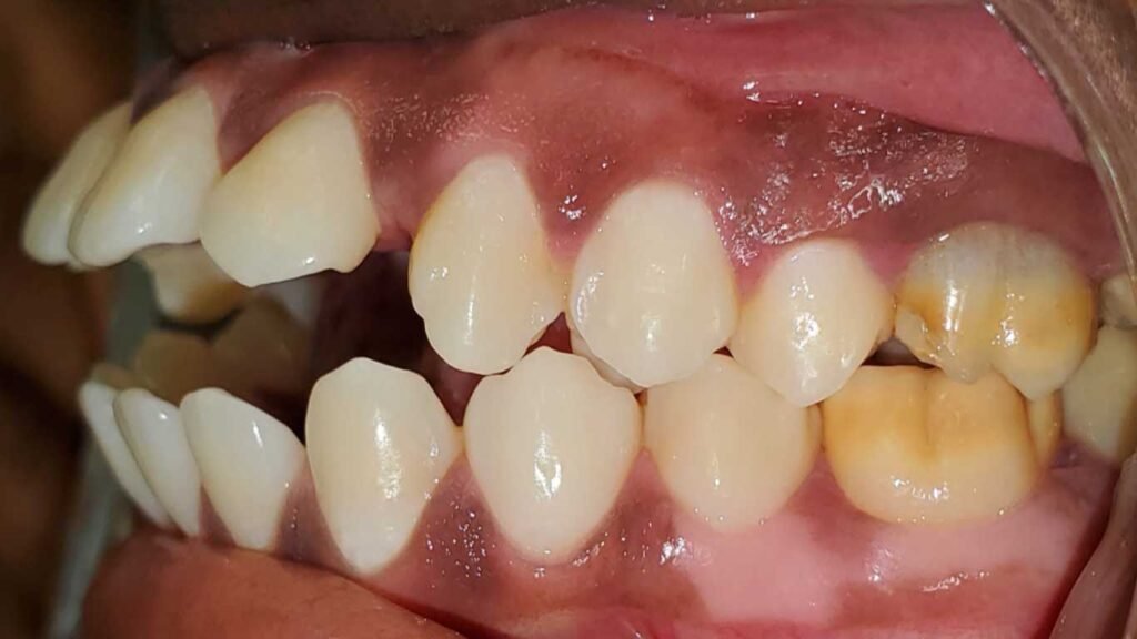 malocclusion-openbite