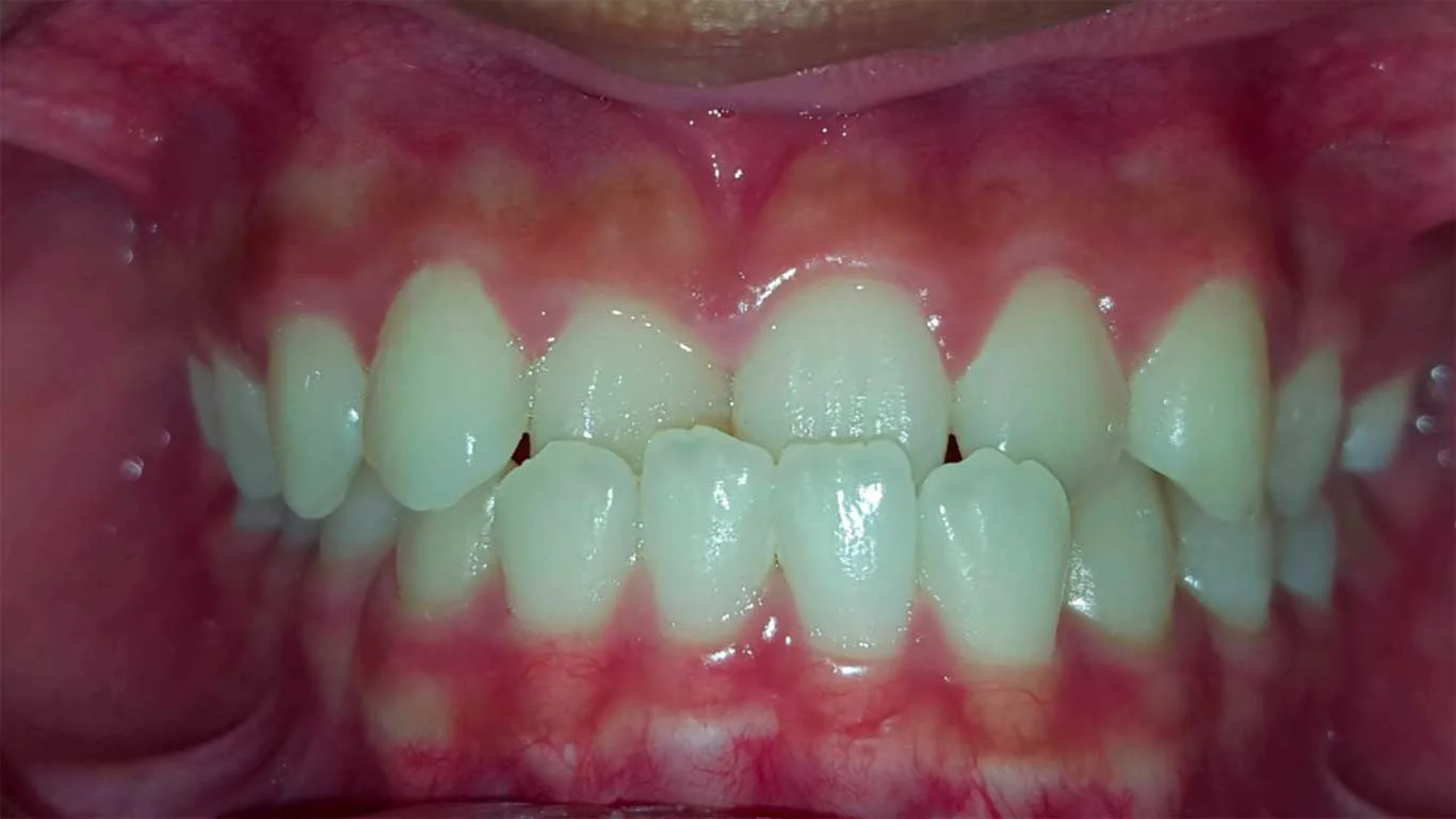 dental malocclusion-crossbite
