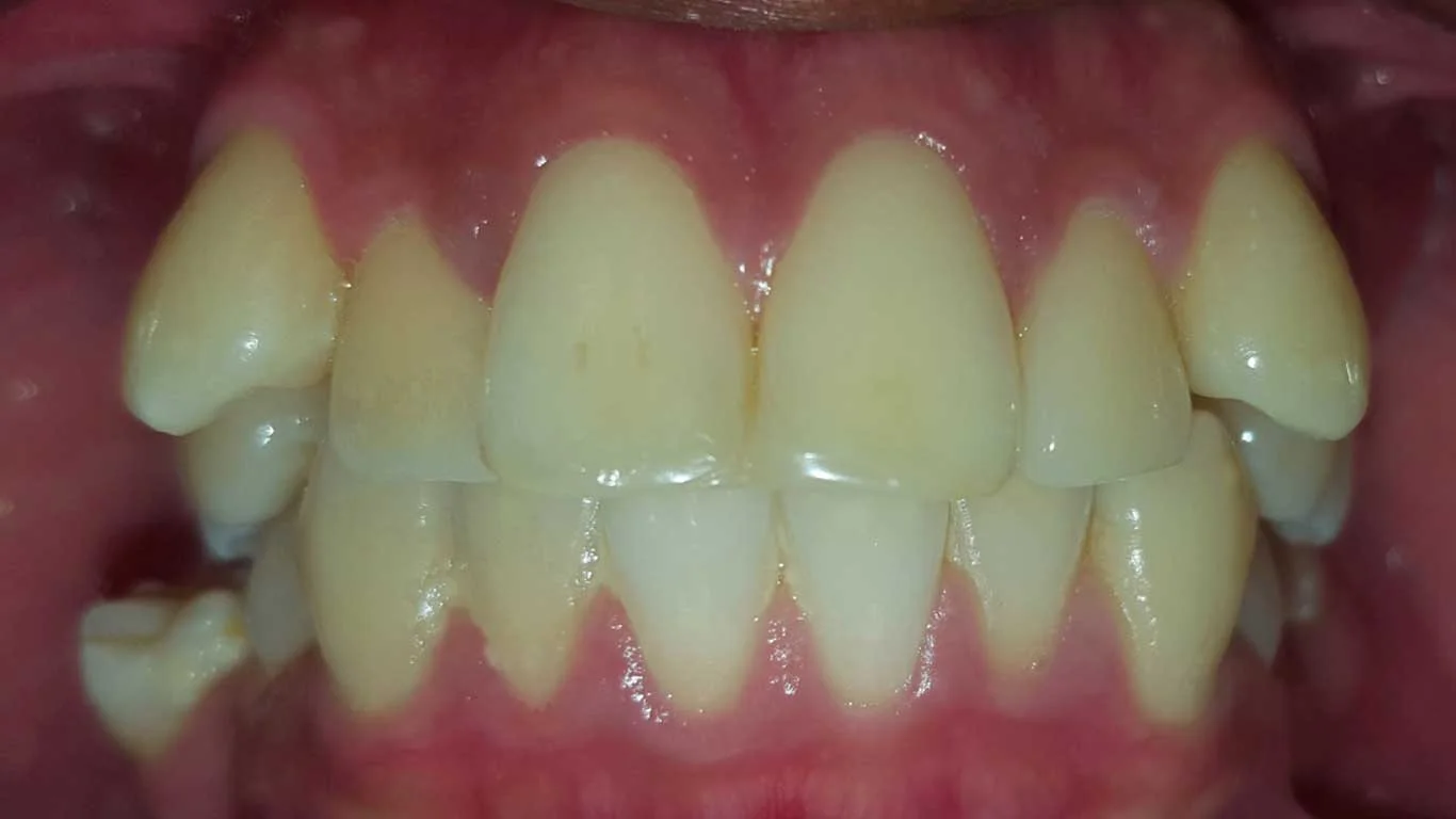 teeth malocclusion-crowding