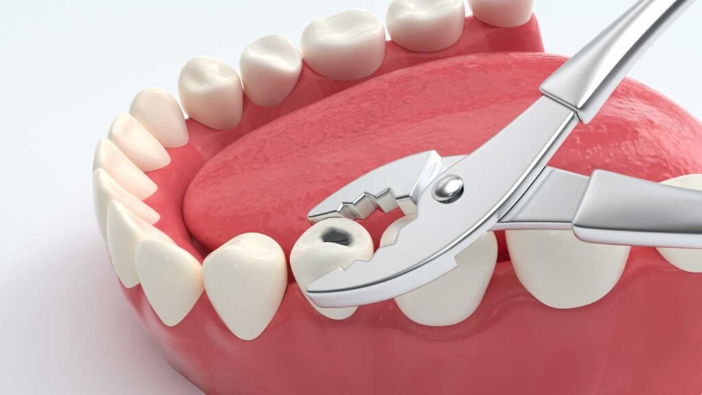 extractions in orthodontcis