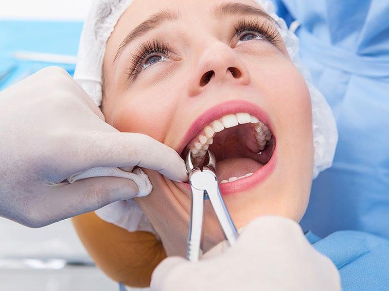 Extractions in Orthodontics