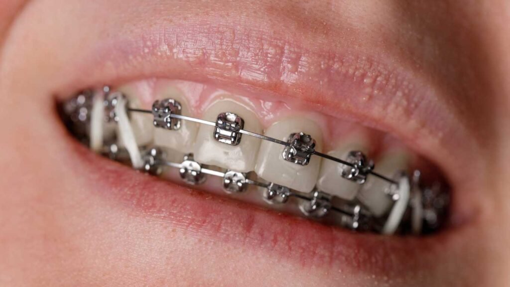 orthodontic elastics