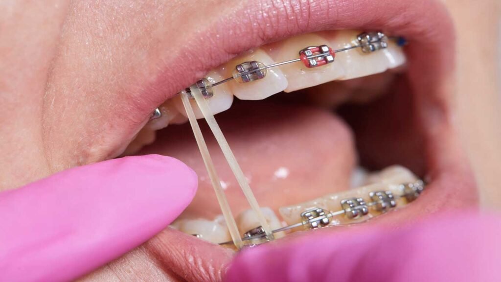 orthodontic treatment