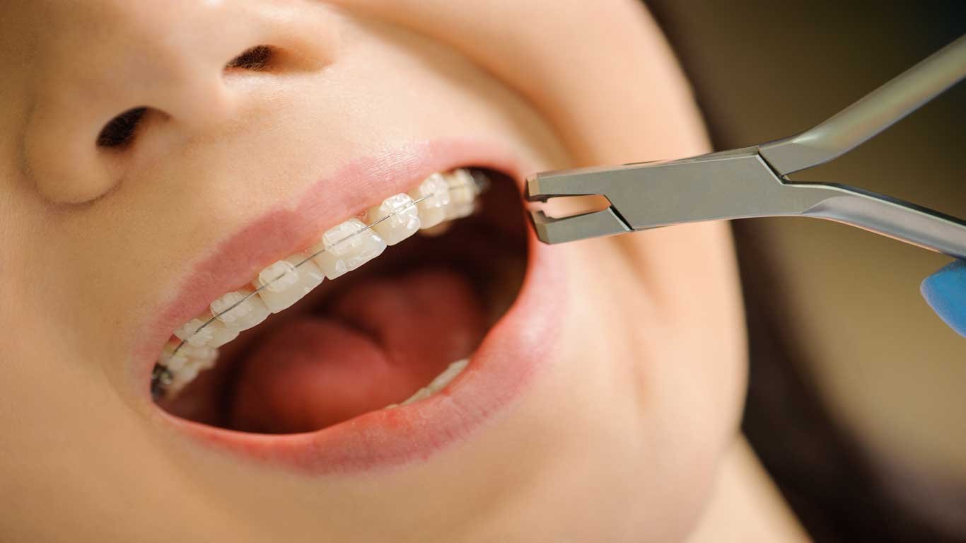 ABC's of Orthodontics-Ceramic braces
