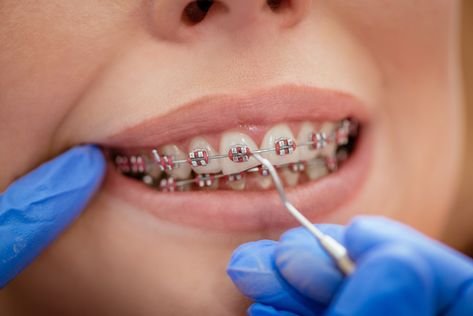 Ceramic Braces: Ancient Origins, Bright Future? Benefits & Drawbacks