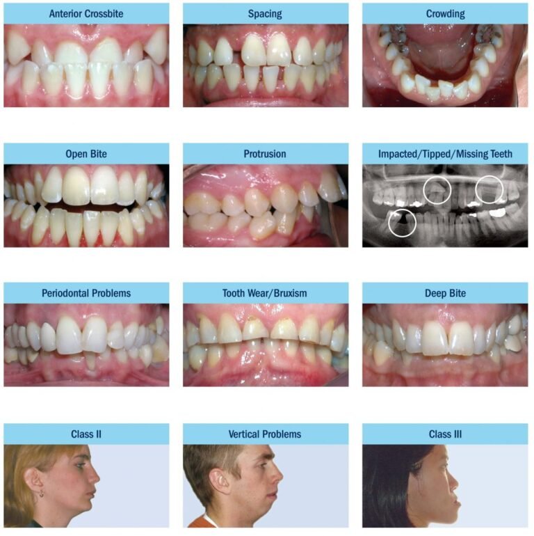 Orthodontic Problems: Understanding The Different Types