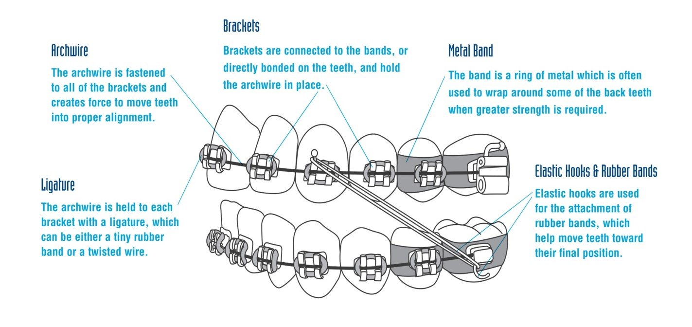Orthodontic Emergencies Orthodontic Services