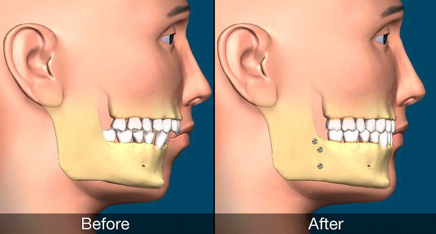 correct jaw alignment