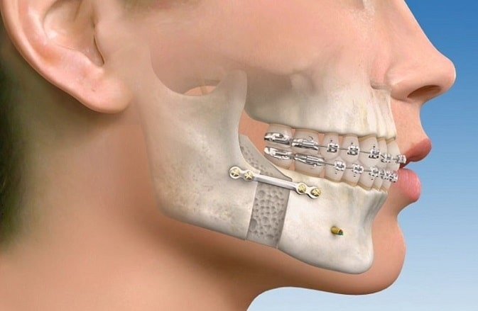 jaw alignment braces