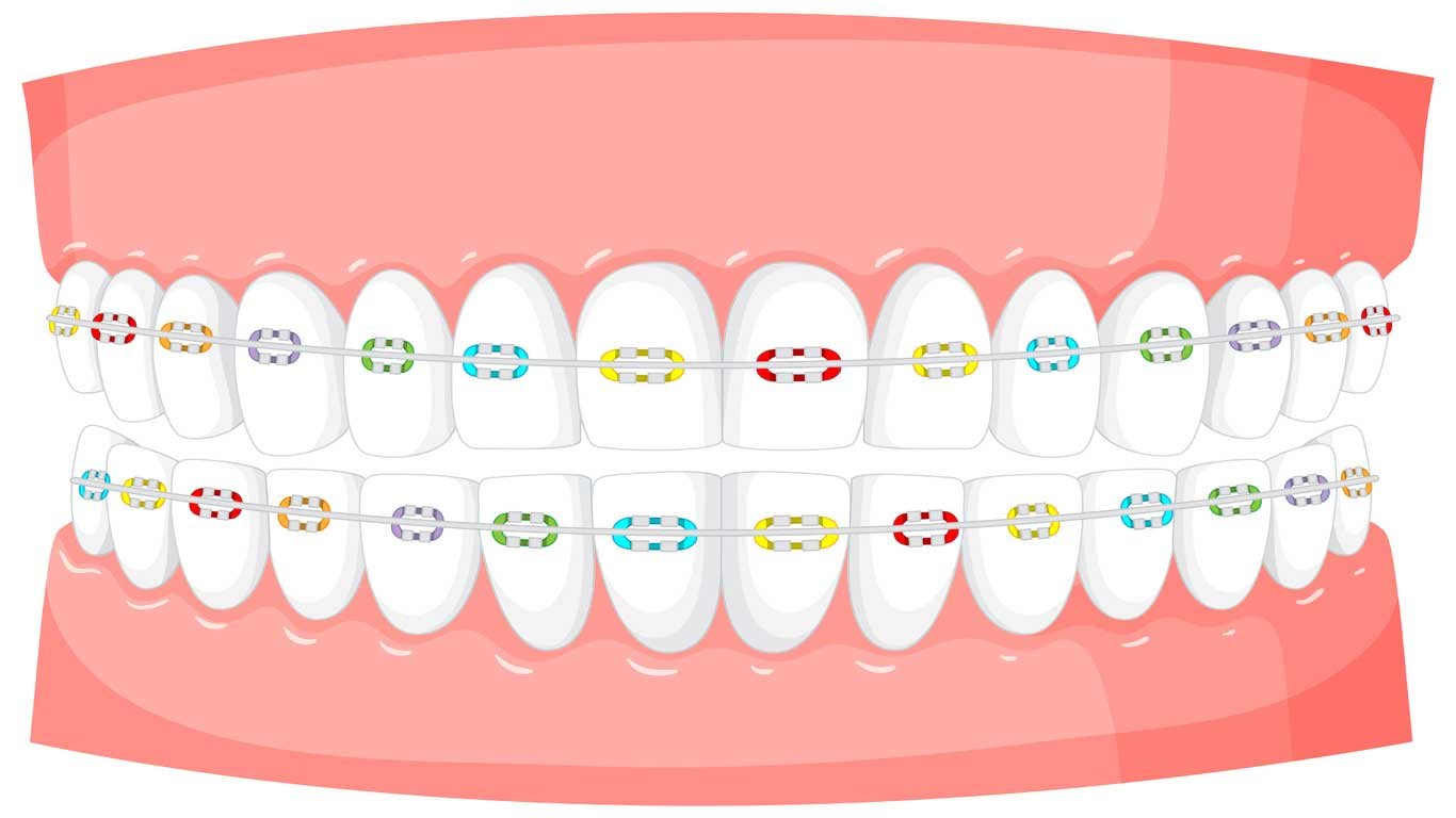 correct jaw alignment by braces