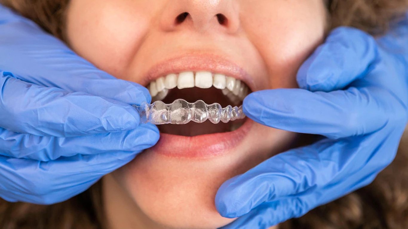 Invisalign vs Braces: Which is Better? - Thornhill Dental Office