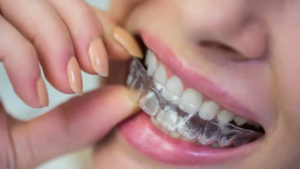 Invisalign aligners