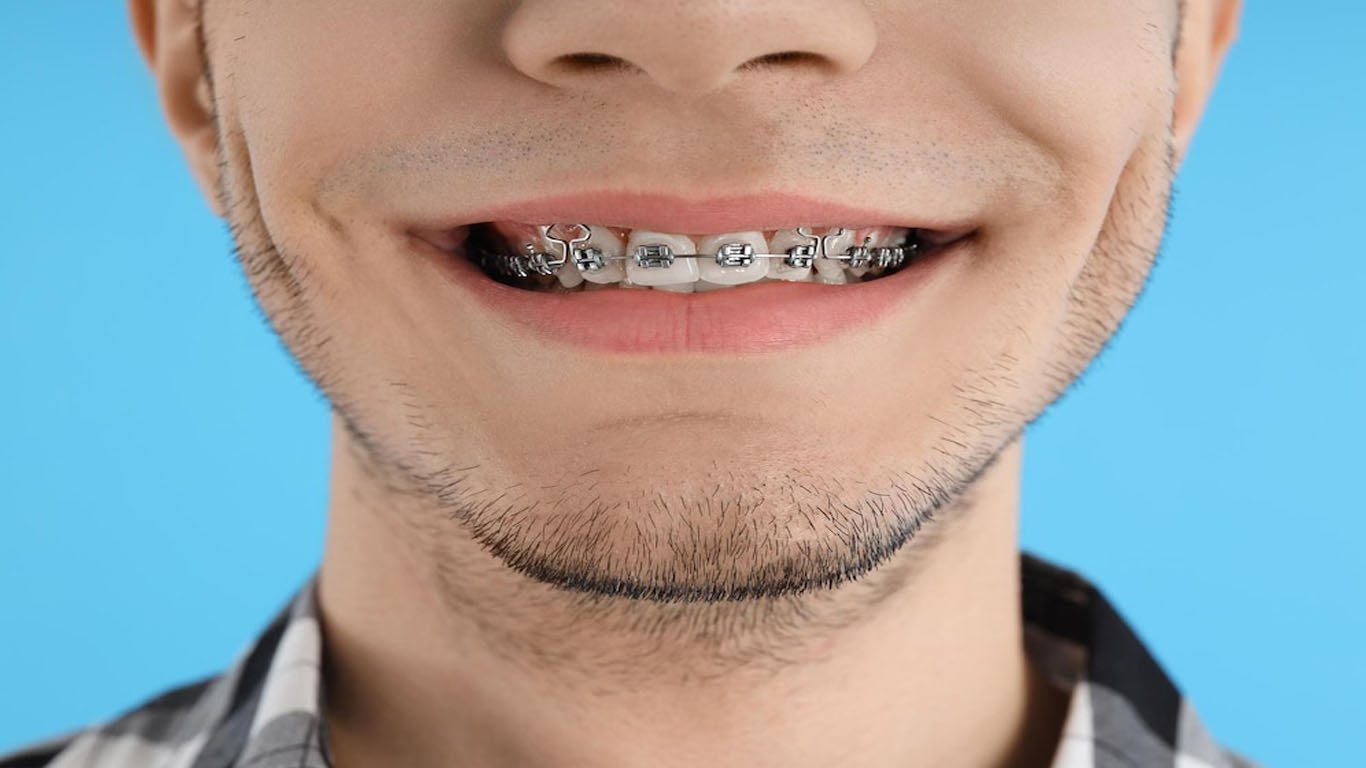 The advantages of braces