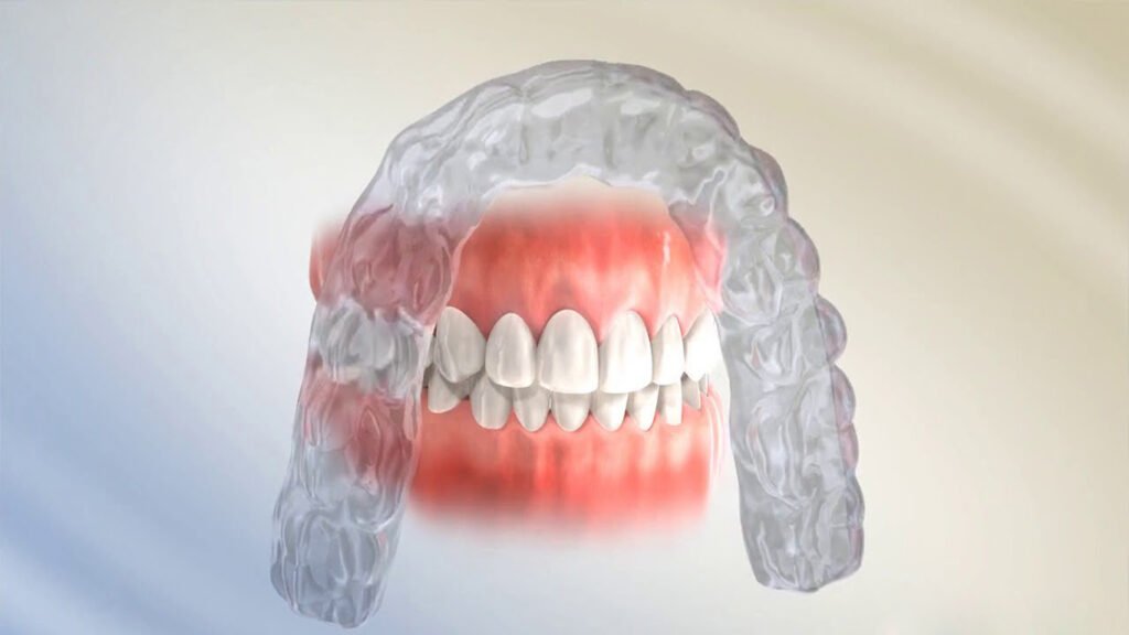 What Are Night Retainers, And Can They Straighten Teeth?
