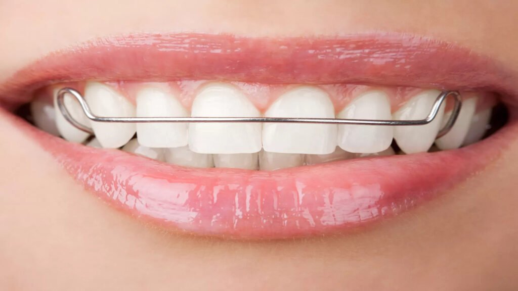 What Are Night Retainers, And Can They Straighten Teeth?