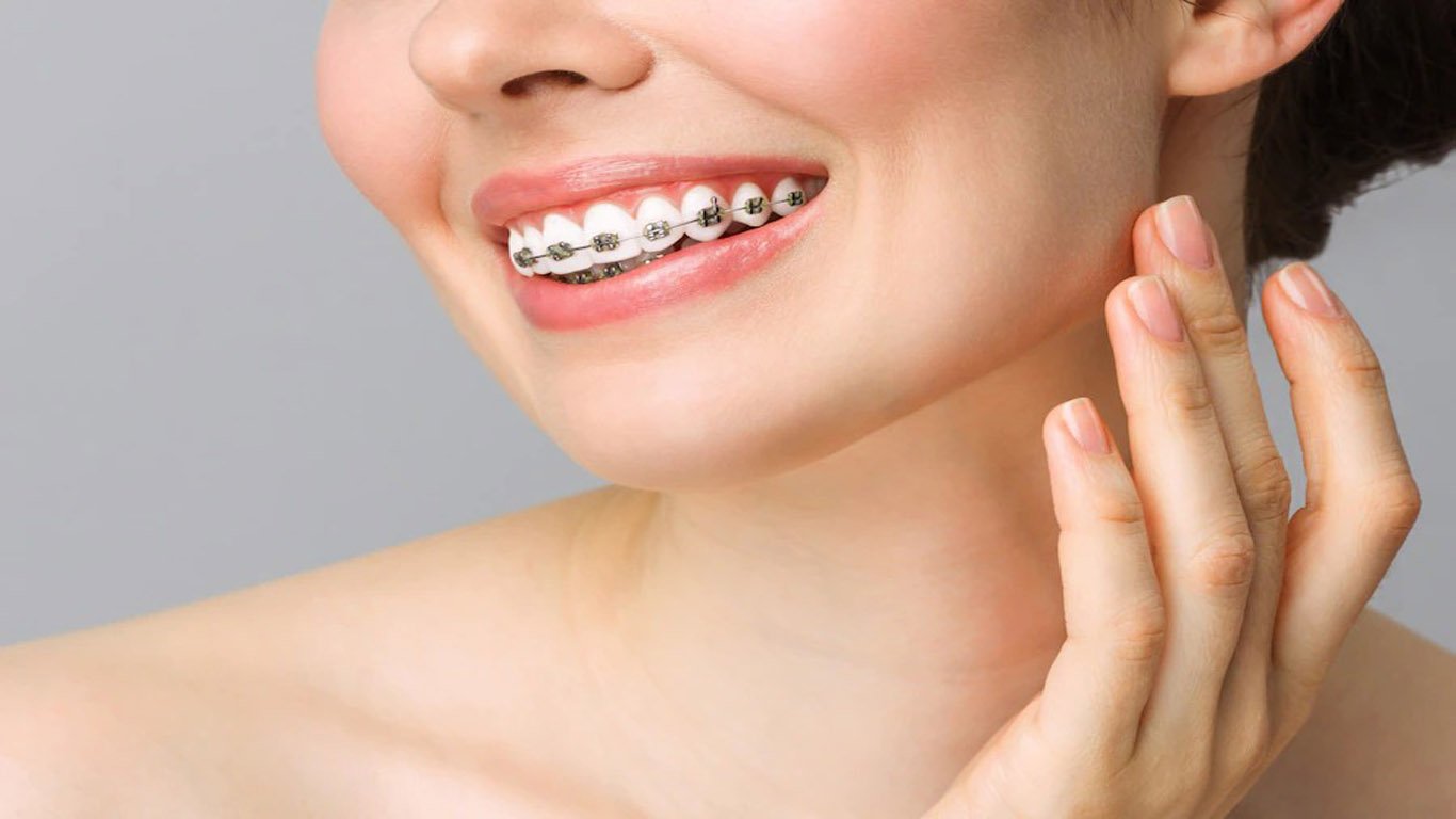 Ceramic Braces: Is it better than Metal Braces? « Smile Team Orthodontics