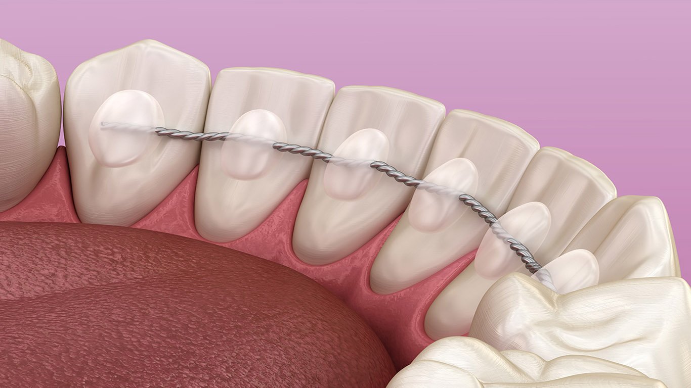 Plastic Vs. Metal Retainers: Which One Is Better?