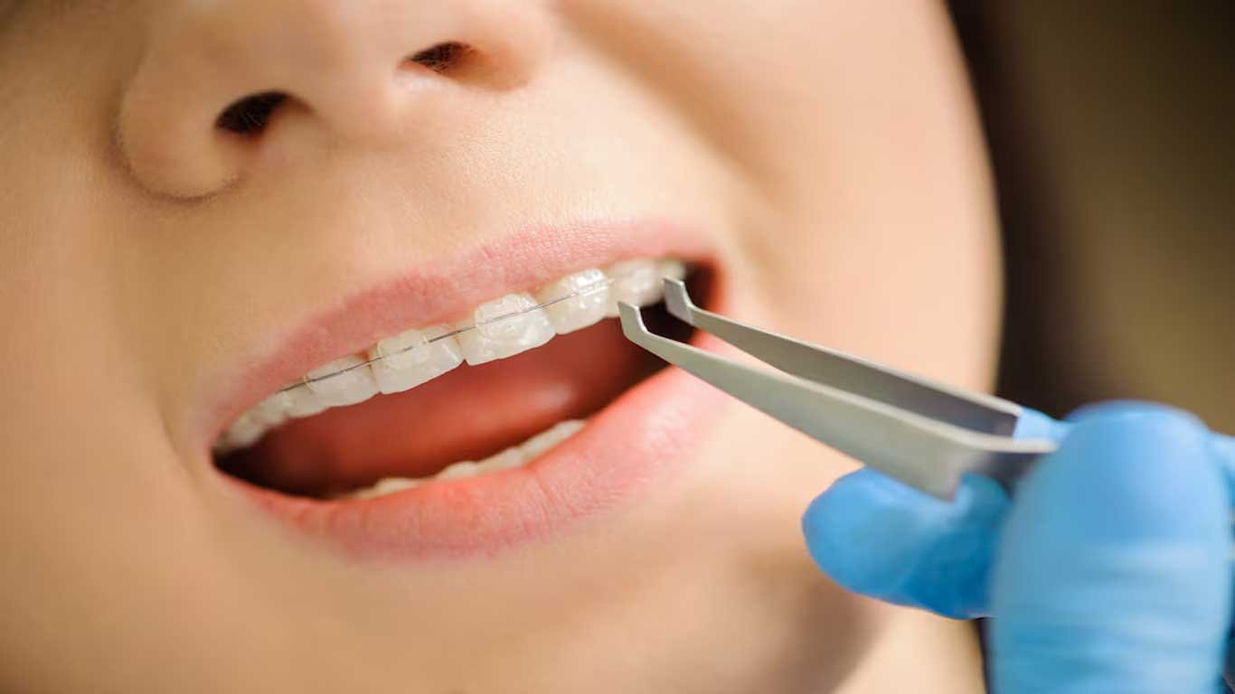 The pros and cons of adult ceramic braces