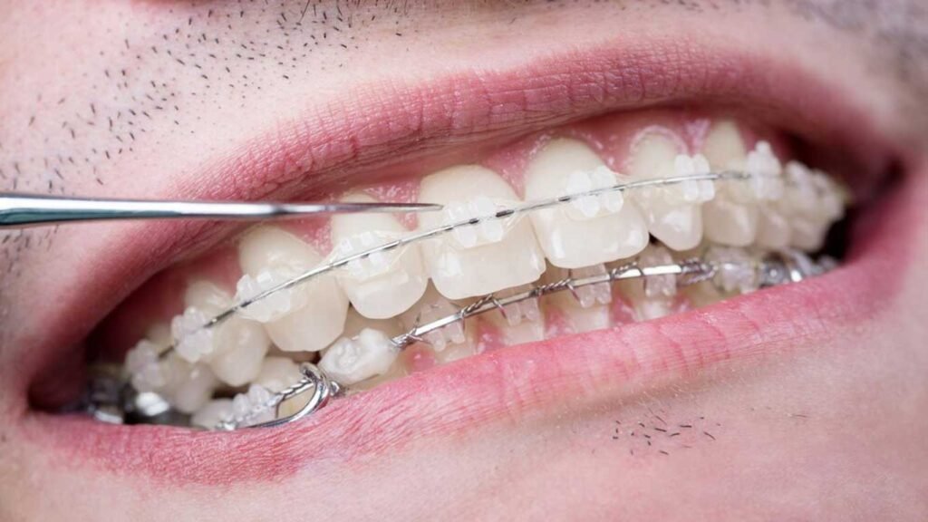 adult ceramic braces