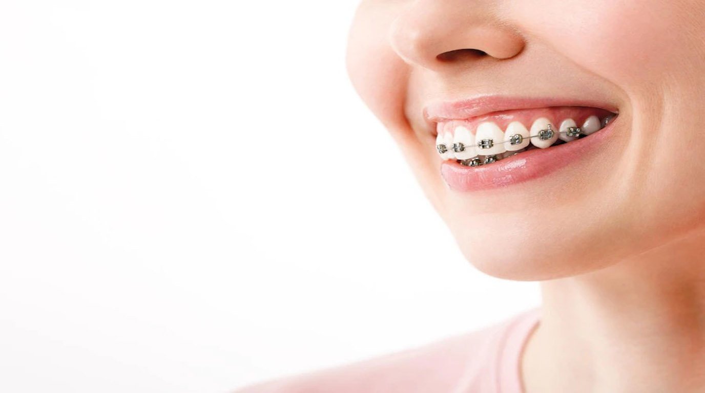 Pros And Cons Of Ceramic Braces