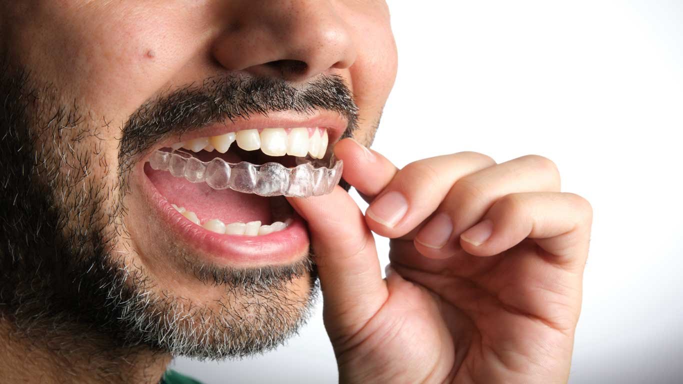 Invisalign aligners vs adult ceramic braces