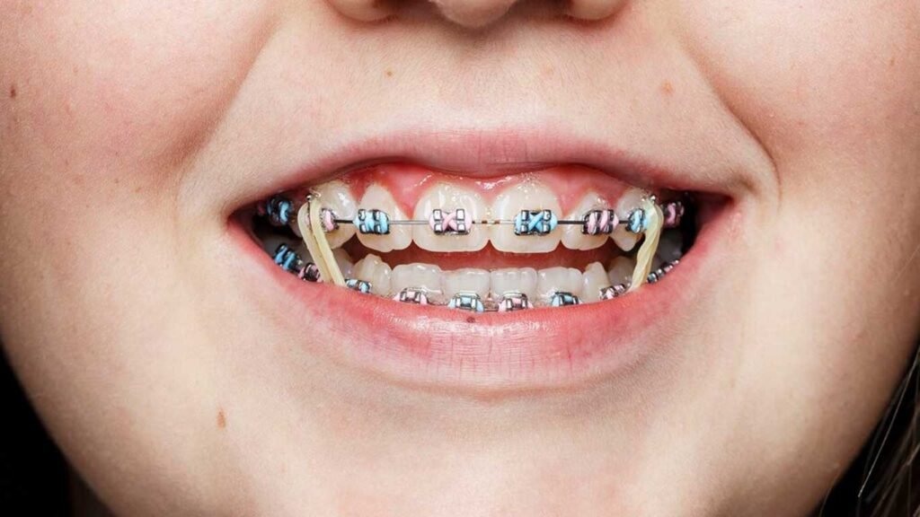 best braces colors