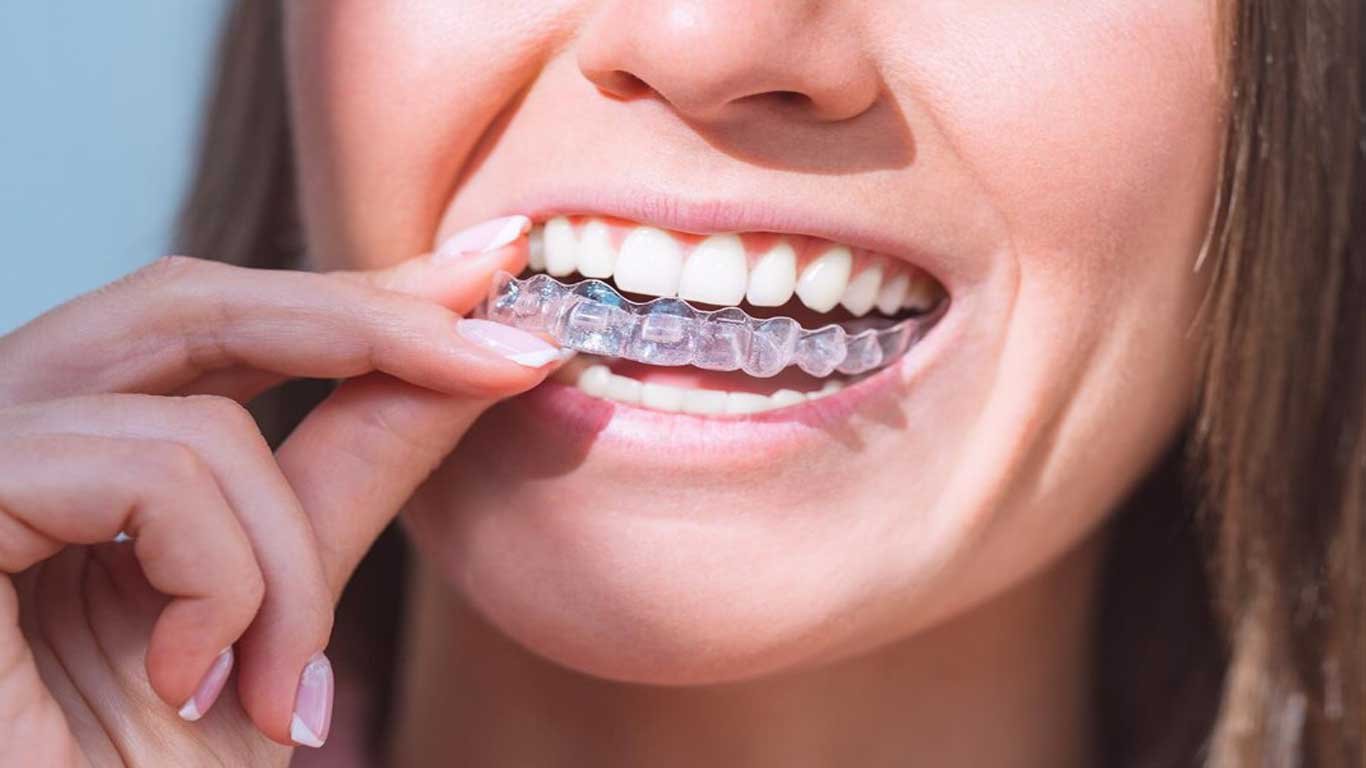 Lingual braces vs. Invisalign