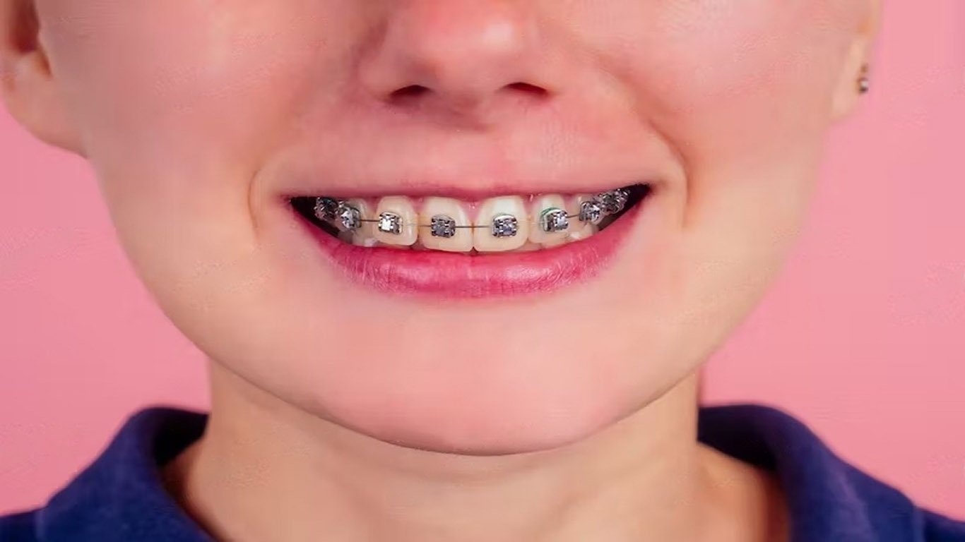 Best Braces Rubber Band Colors Worcester