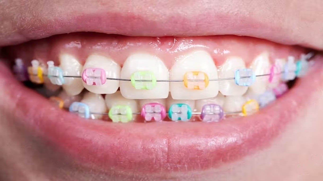 the best braces color