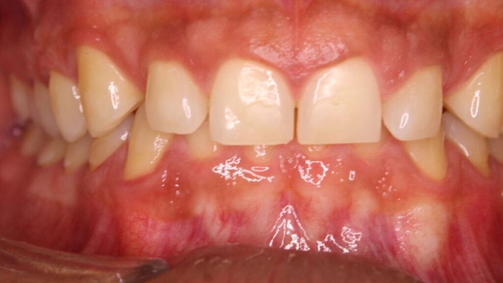 overbite braces