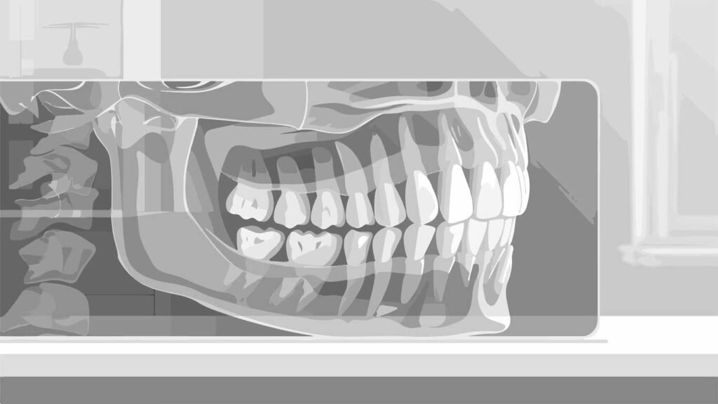 molar bands with cleats