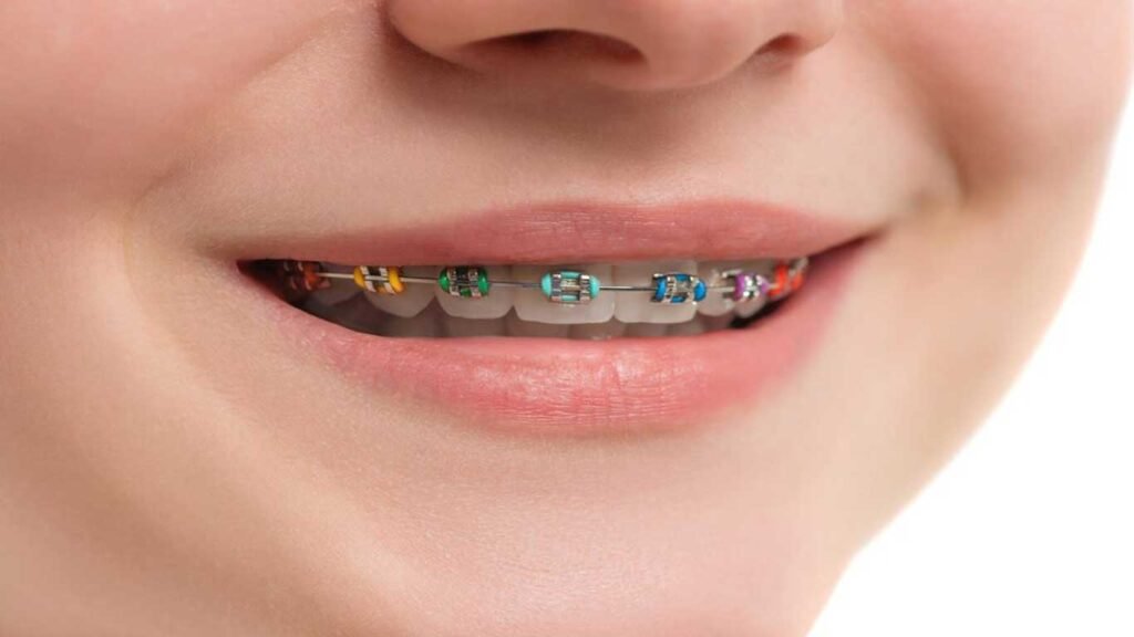 orthodontic moalr bands