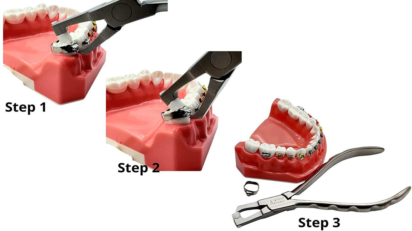 molar band removal