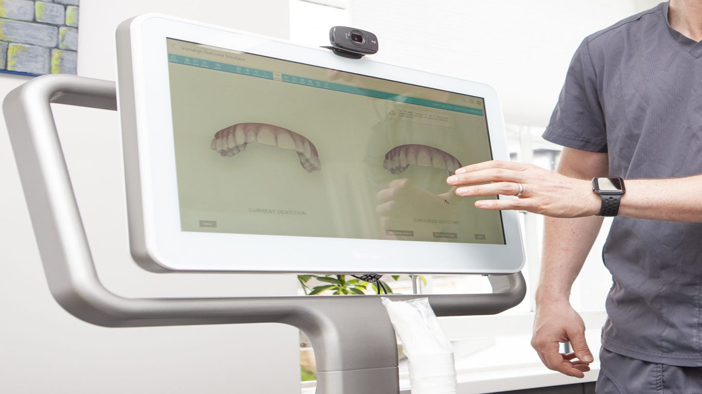 What Is the iTero Invisalign Scanner